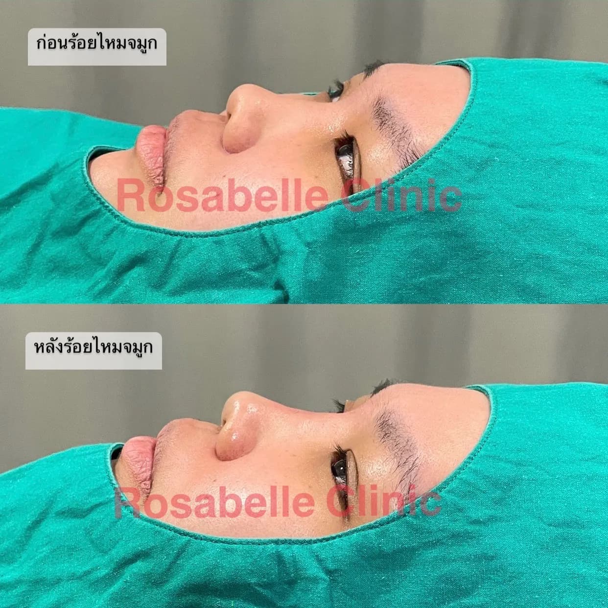 ภาพประกอบเสริมจมูกแบบไม่ผ่าตัด ร้อยไหมจมูก VS ฟิลเลอร์จมูก ลำดับที่ 1