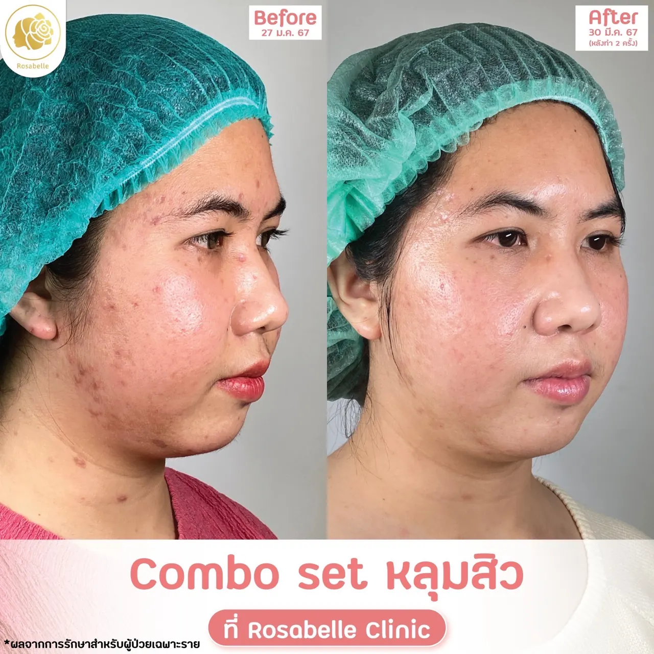 ภาพประกอบขั้นตอนโปรแกรมรักษาหลุมสิวที่ Rosabelle Clinic ลำดับที่ 7