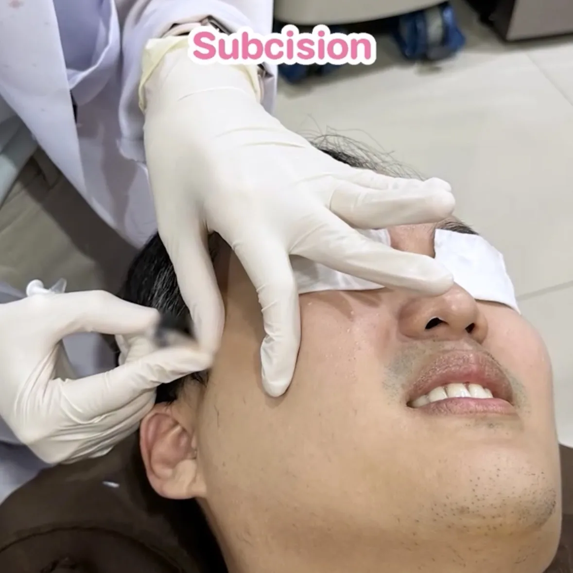 ขั้นตอนโปรแกรมรักษาหลุมสิวที่ Rosabelle Clinic