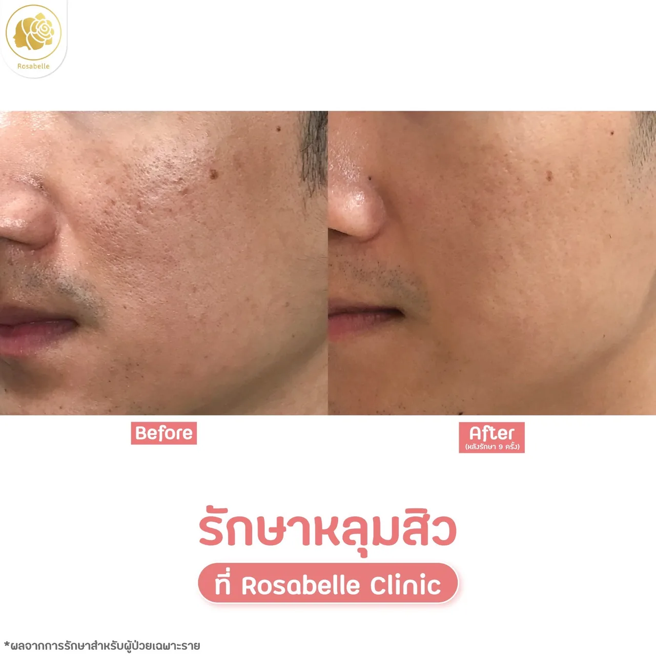 ภาพประกอบขั้นตอนโปรแกรมรักษาหลุมสิวที่ Rosabelle Clinic ลำดับที่ 5