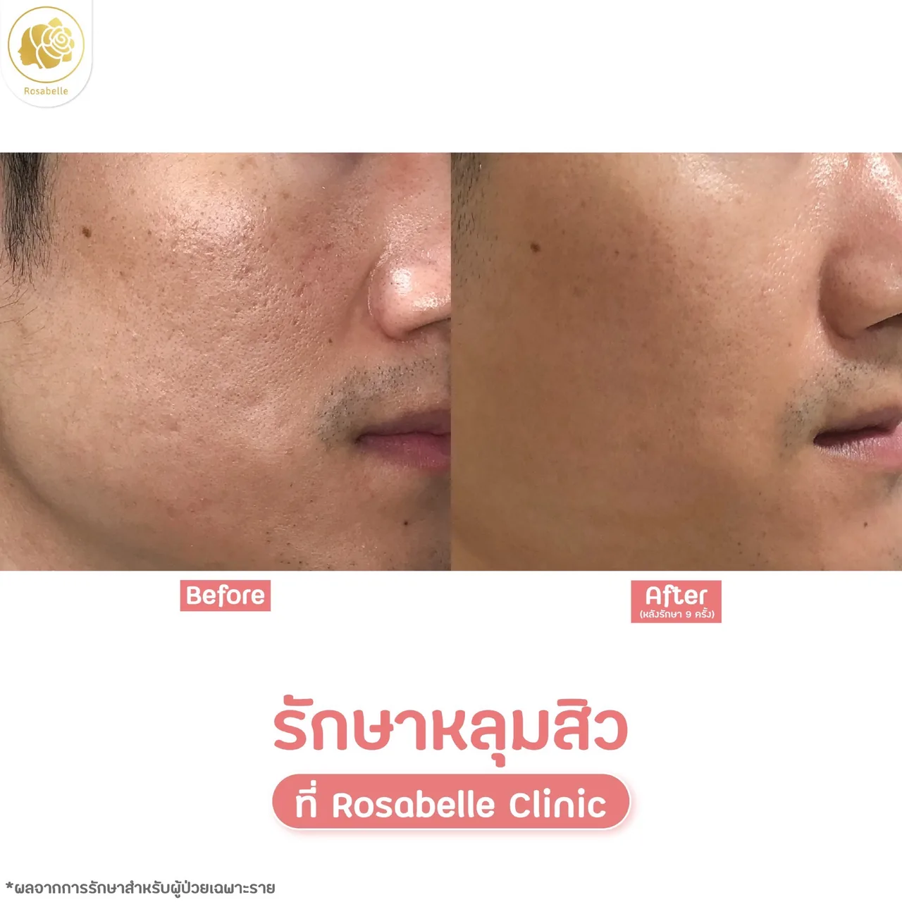 ภาพประกอบขั้นตอนโปรแกรมรักษาหลุมสิวที่ Rosabelle Clinic ลำดับที่ 6