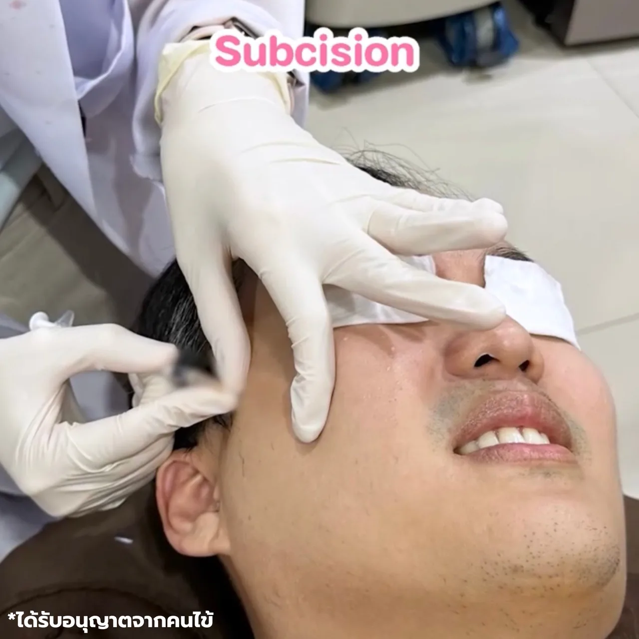 โปรแกรม Subcision และ PDRN คืออะไร? ทำร่วมกันอย่างไร