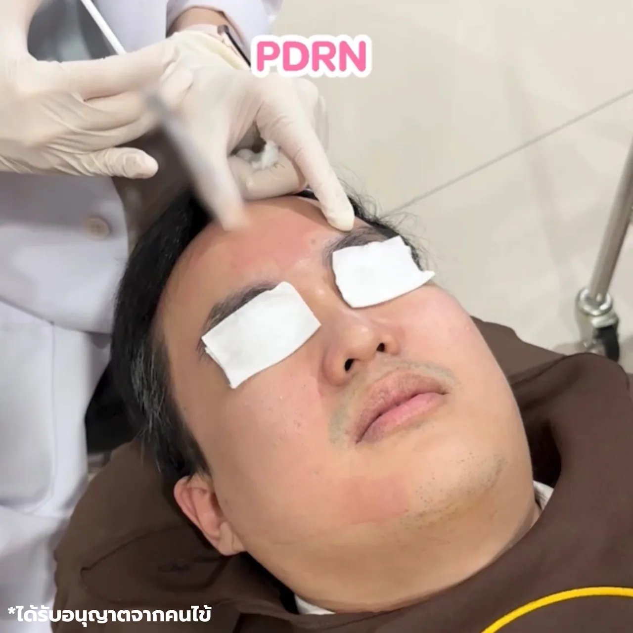 ภาพประกอบโปรแกรม Subcision และ PDRN คืออะไร? ทำร่วมกันอย่างไร ลำดับที่ 1