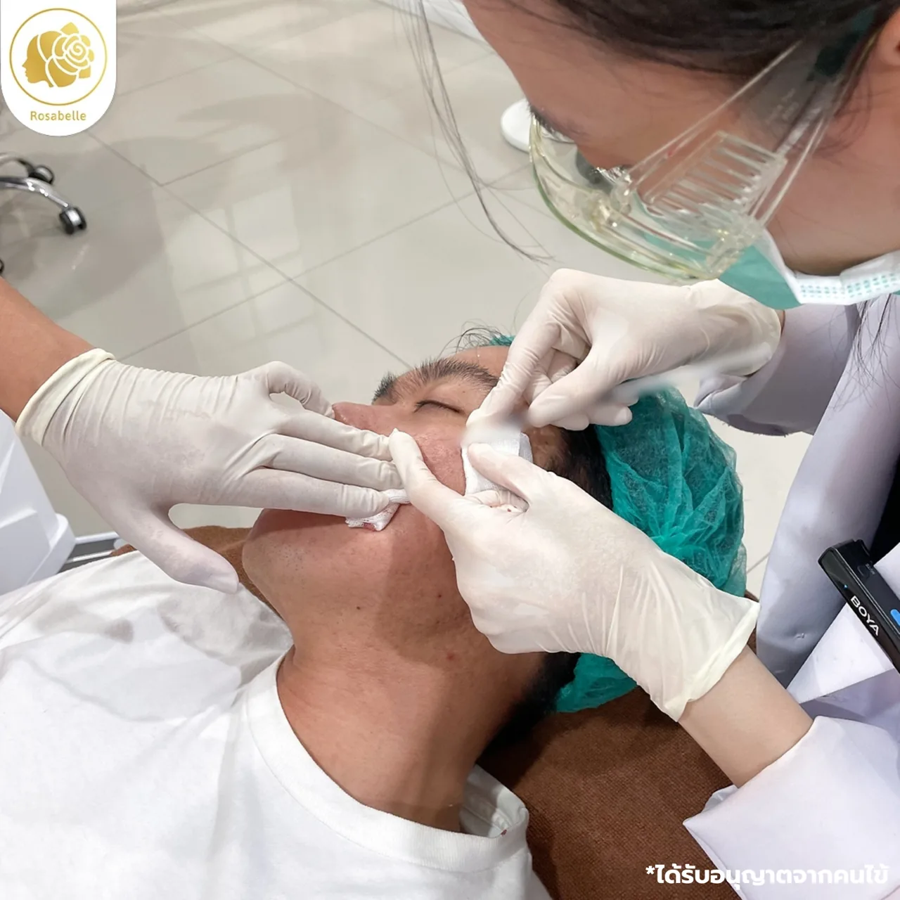 ภาพประกอบโปรแกรม Subcision และ PDRN คืออะไร? ทำร่วมกันอย่างไร ลำดับที่ 2