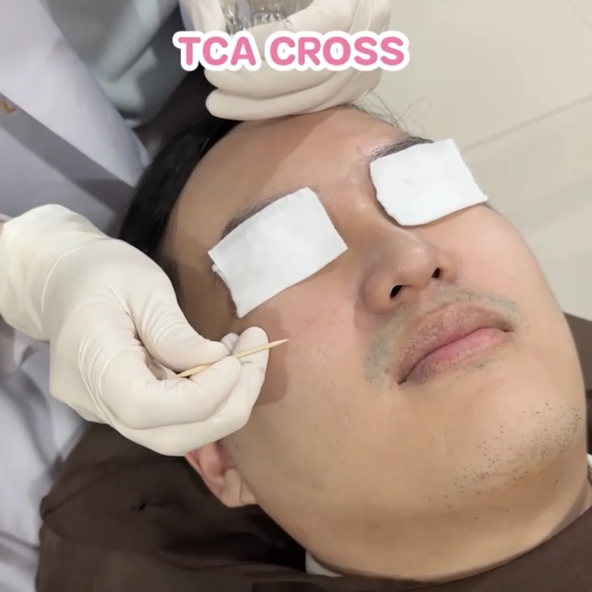 ภาพประกอบรีวิวโปรแกรม Combo Set รักษาหลุมสิว ที่ Rosabelle Clinic ลำดับที่ 15