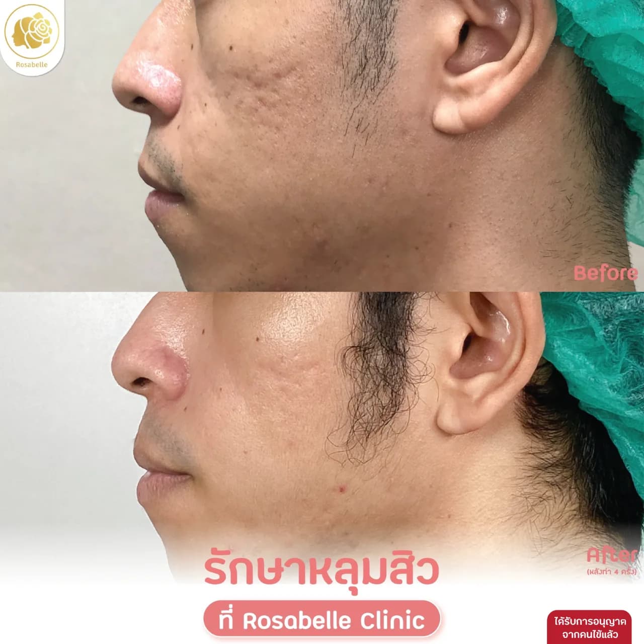 ภาพประกอบโปรแกรม Combo Set รักษาหลุมสิว: ขั้นตอน การเตรียมตัว และการดูแลหลังทำ ลำดับที่ 7