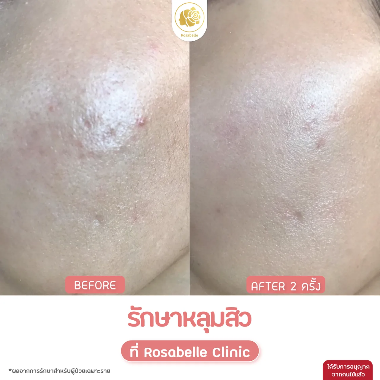 ภาพประกอบโปรแกรม Combo Set รักษาหลุมสิว: ขั้นตอน การเตรียมตัว และการดูแลหลังทำ ลำดับที่ 9