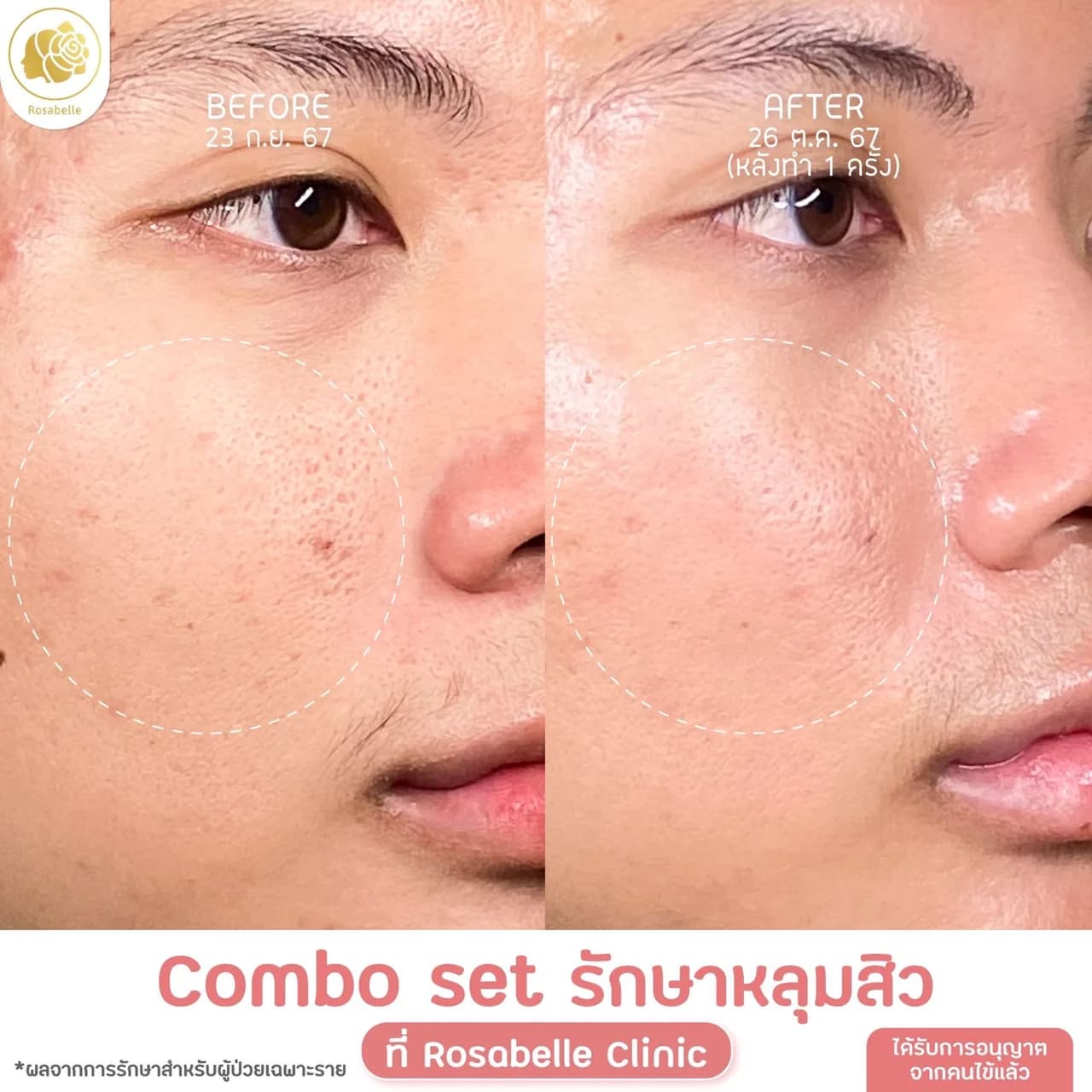 ภาพประกอบโปรแกรม Combo Set รักษาหลุมสิว: ขั้นตอน การเตรียมตัว และการดูแลหลังทำ ลำดับที่ 4