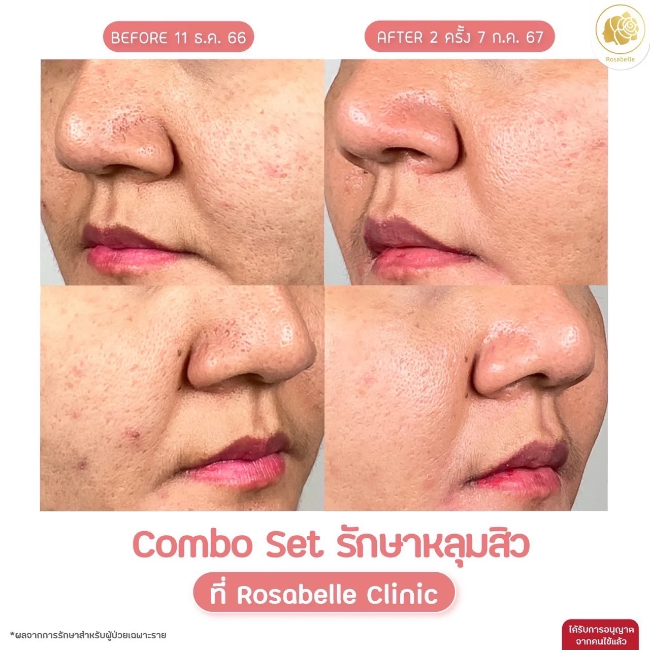 รีวิวโปรแกรม Combo Set รักษาหลุมสิว ที่ Rosabelle Clinic