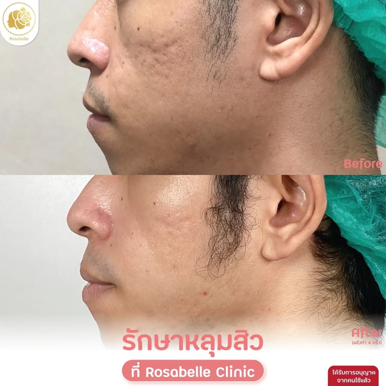 ภาพประกอบรีวิวโปรแกรม Combo Set รักษาหลุมสิว ที่ Rosabelle Clinic ลำดับที่ 9