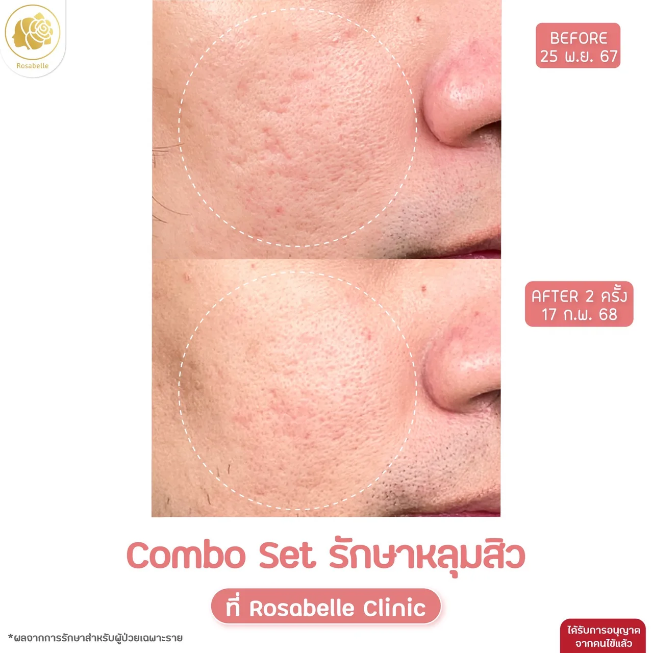 ภาพประกอบรีวิวโปรแกรม Combo Set รักษาหลุมสิว ที่ Rosabelle Clinic ลำดับที่ 10