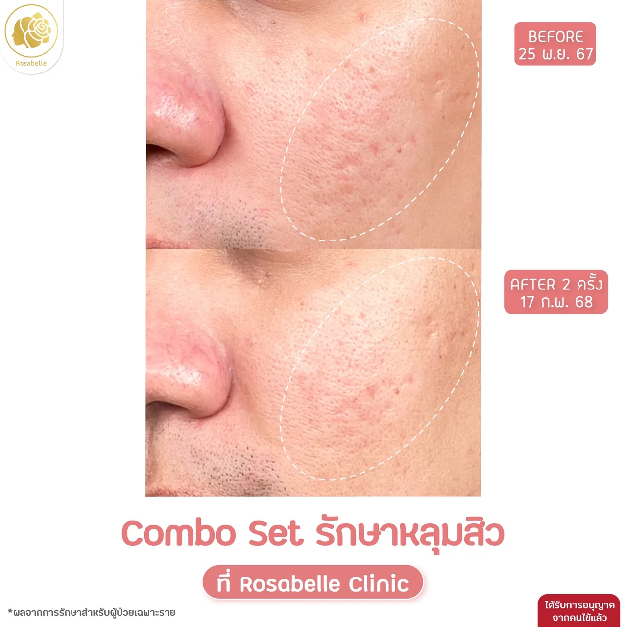 ภาพประกอบรีวิวโปรแกรม Combo Set รักษาหลุมสิว ที่ Rosabelle Clinic ลำดับที่ 11