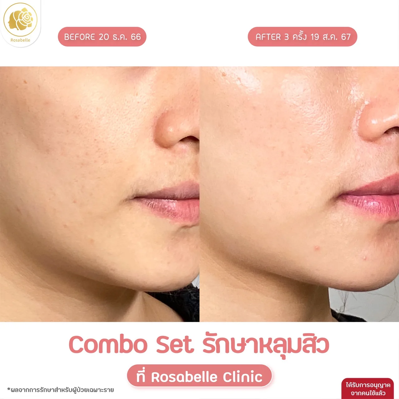 ภาพประกอบรีวิวโปรแกรม Combo Set รักษาหลุมสิว ที่ Rosabelle Clinic ลำดับที่ 12