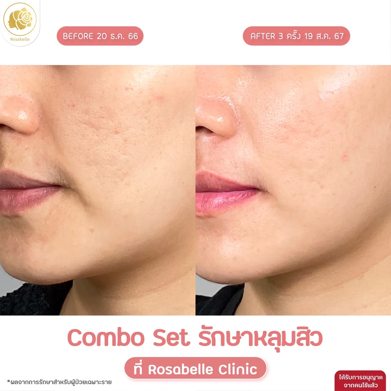 ภาพประกอบรีวิวโปรแกรม Combo Set รักษาหลุมสิว ที่ Rosabelle Clinic ลำดับที่ 13