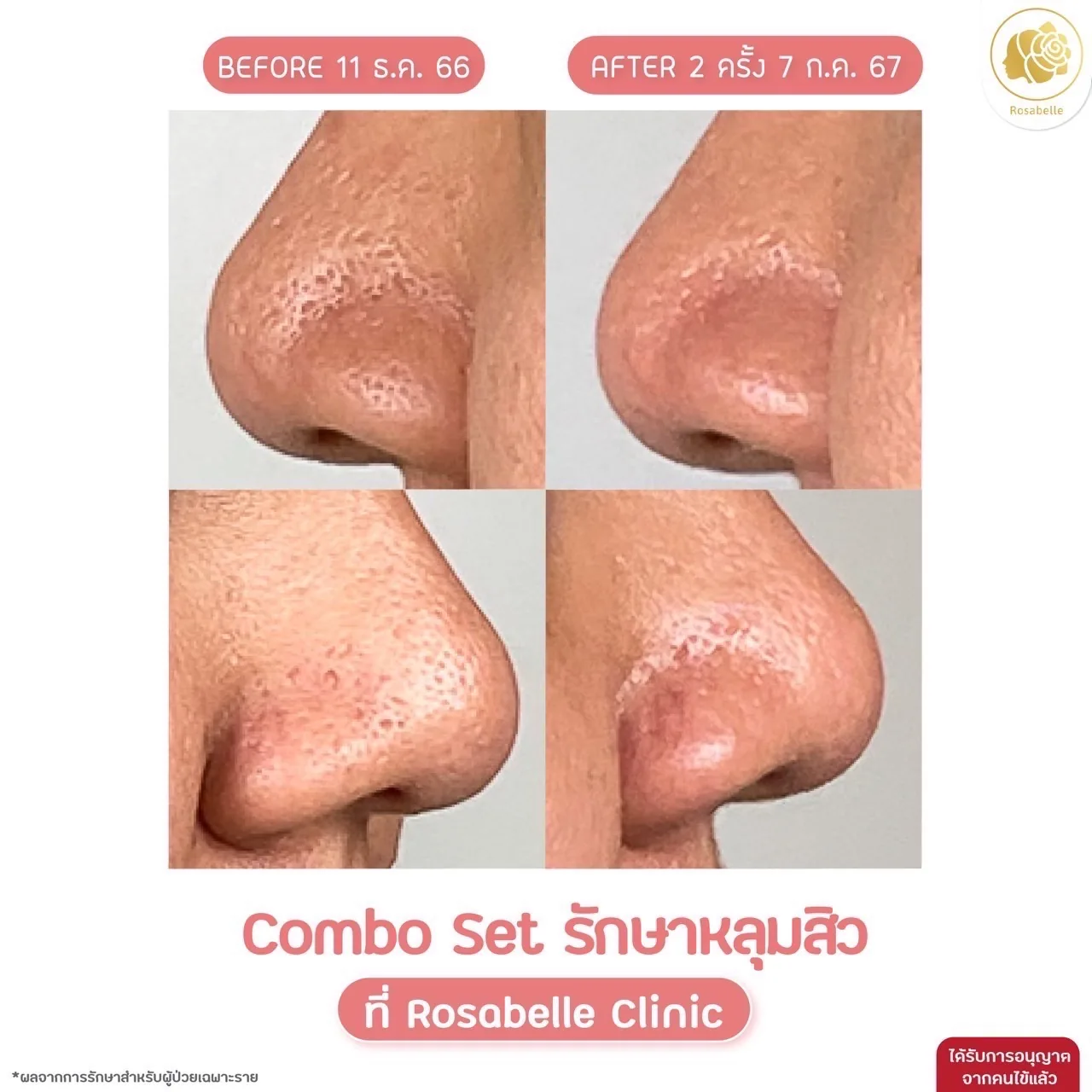 ภาพประกอบรีวิวโปรแกรม Combo Set รักษาหลุมสิว ที่ Rosabelle Clinic ลำดับที่ 1