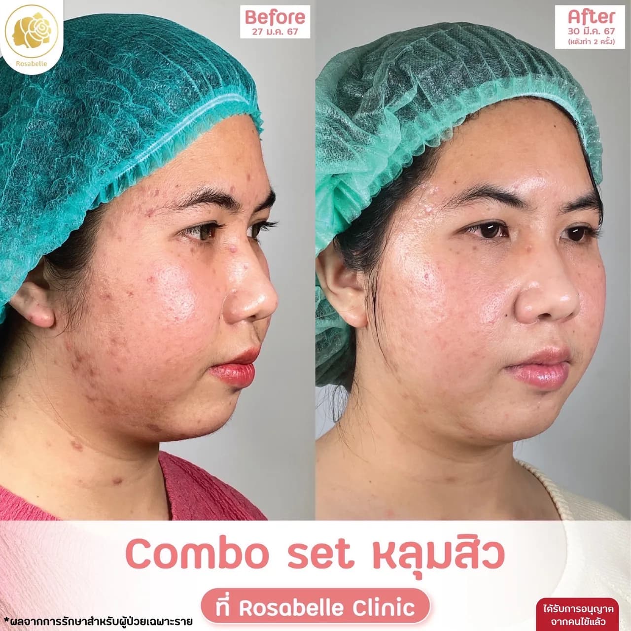 ภาพประกอบรีวิวโปรแกรม Combo Set รักษาหลุมสิว ที่ Rosabelle Clinic ลำดับที่ 2