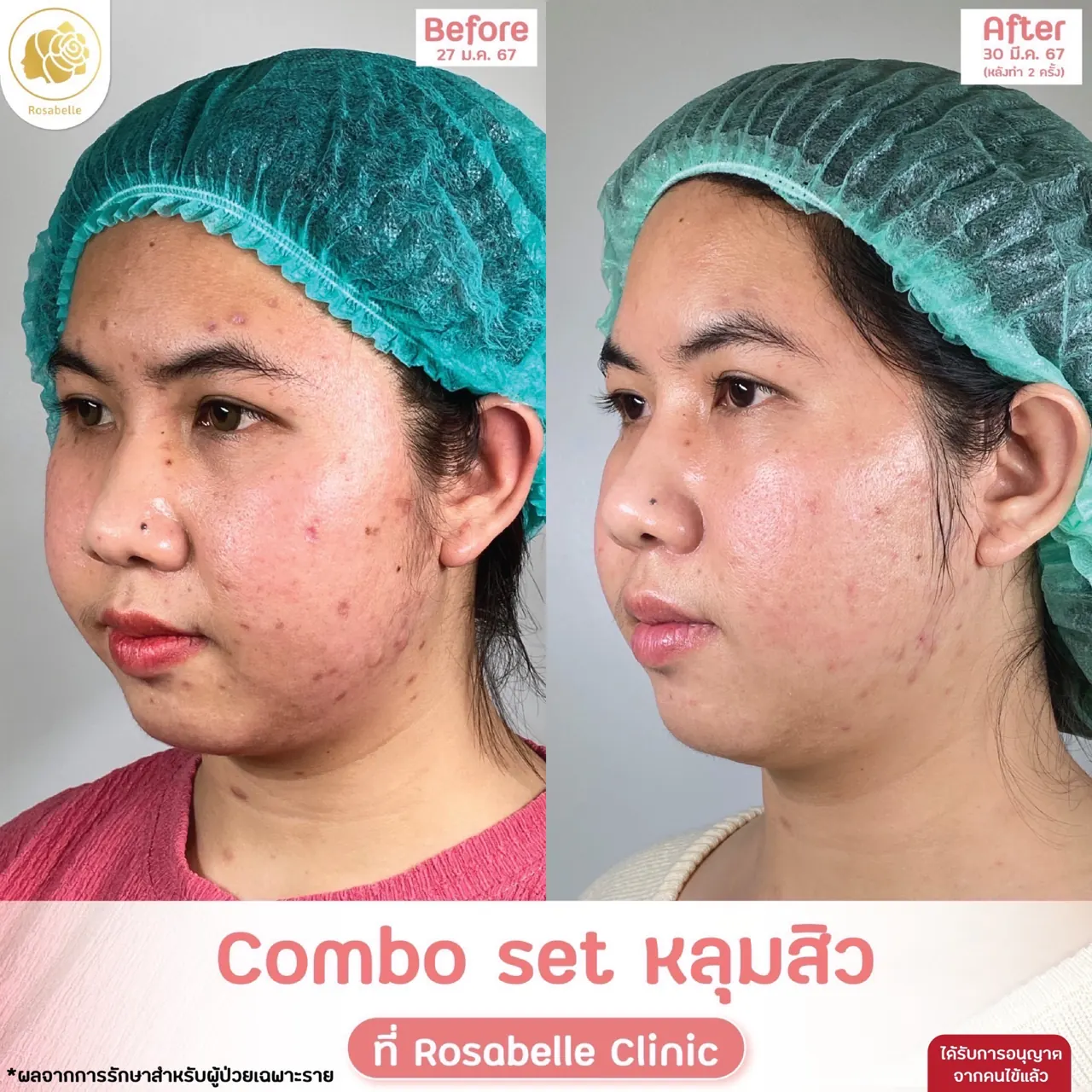 ภาพประกอบรีวิวโปรแกรม Combo Set รักษาหลุมสิว ที่ Rosabelle Clinic ลำดับที่ 3