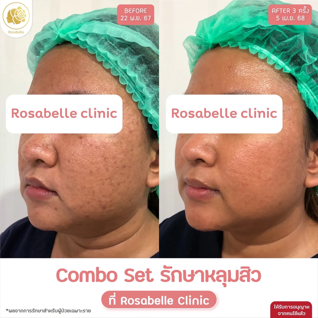 ภาพประกอบรีวิวโปรแกรม Combo Set รักษาหลุมสิว ที่ Rosabelle Clinic ลำดับที่ 4