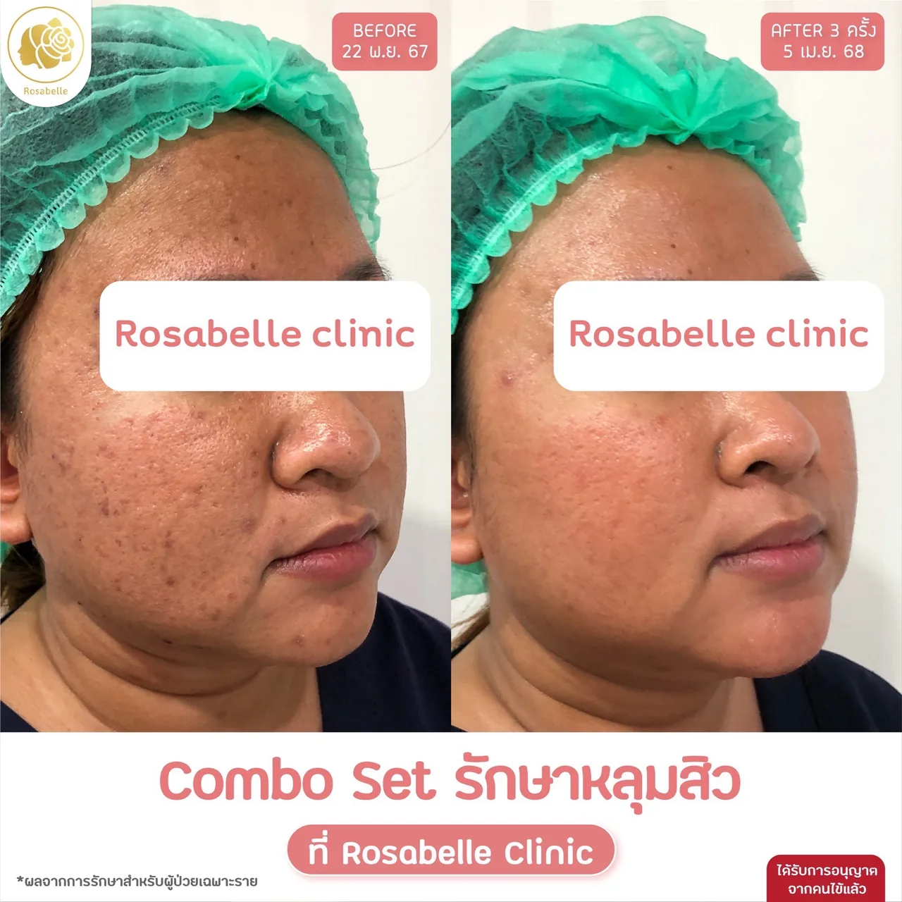ภาพประกอบรีวิวโปรแกรม Combo Set รักษาหลุมสิว ที่ Rosabelle Clinic ลำดับที่ 5