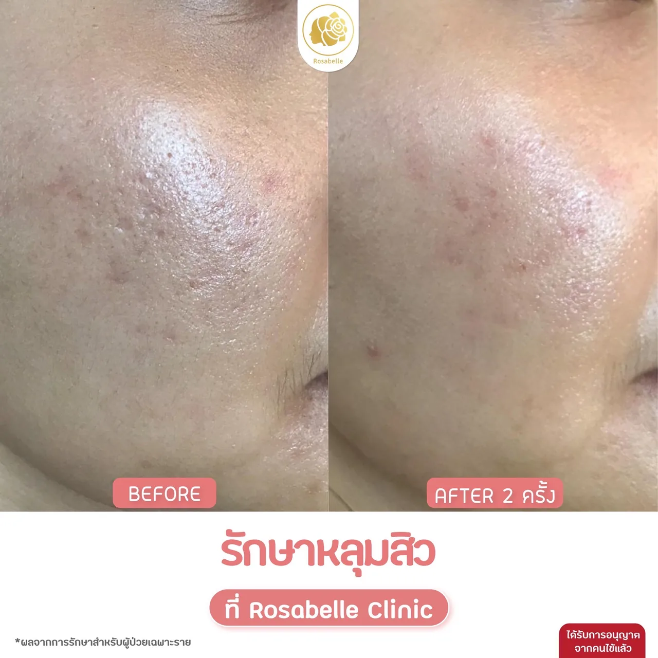 ภาพประกอบรีวิวโปรแกรม Combo Set รักษาหลุมสิว ที่ Rosabelle Clinic ลำดับที่ 6