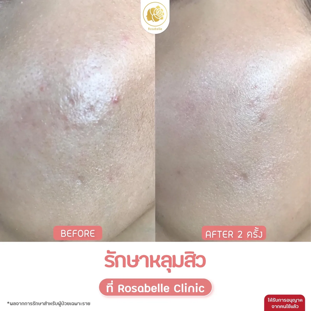 ภาพประกอบรีวิวโปรแกรม Combo Set รักษาหลุมสิว ที่ Rosabelle Clinic ลำดับที่ 7