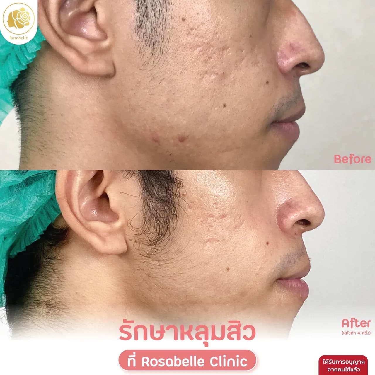 ภาพประกอบรีวิวโปรแกรม Combo Set รักษาหลุมสิว ที่ Rosabelle Clinic ลำดับที่ 8