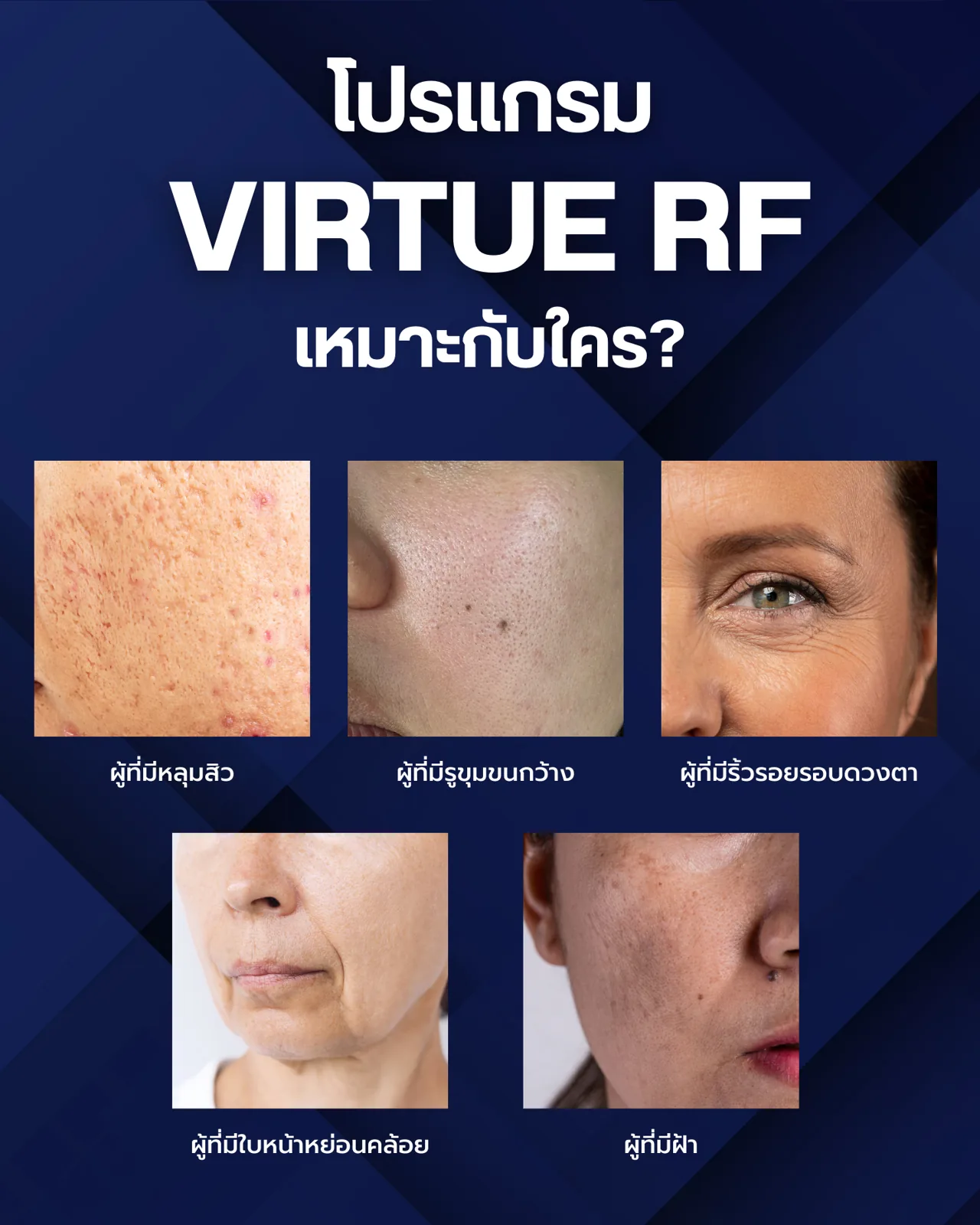 โปรแกรม Microneedle RF: หลักการทำงานและหัว โปรแกรม Smart RF, โปรแกรม Deep RF, โปรแกรม Exact RF