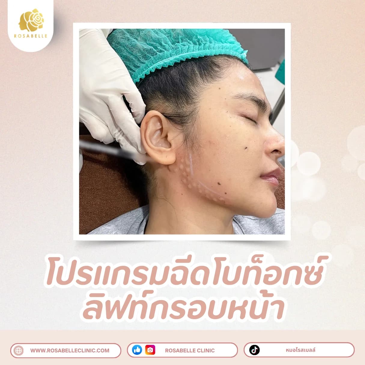 ภาพประกอบรวมโปรแกรมปรับรูปหน้าและยกกระชับ ที่ Rosabelle Clinic ลำดับที่ 2