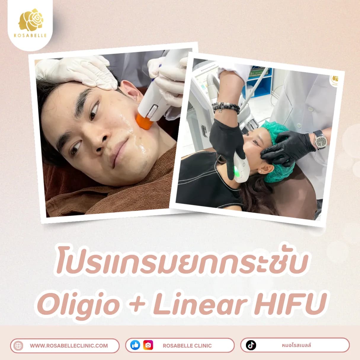 ภาพประกอบรวมโปรแกรมปรับรูปหน้าและยกกระชับ ที่ Rosabelle Clinic ลำดับที่ 7