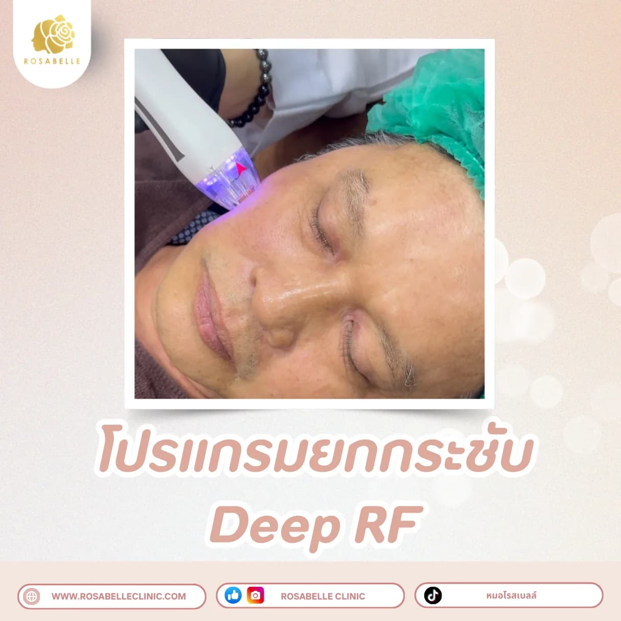ภาพประกอบรวมโปรแกรมปรับรูปหน้าและยกกระชับ ที่ Rosabelle Clinic ลำดับที่ 8
