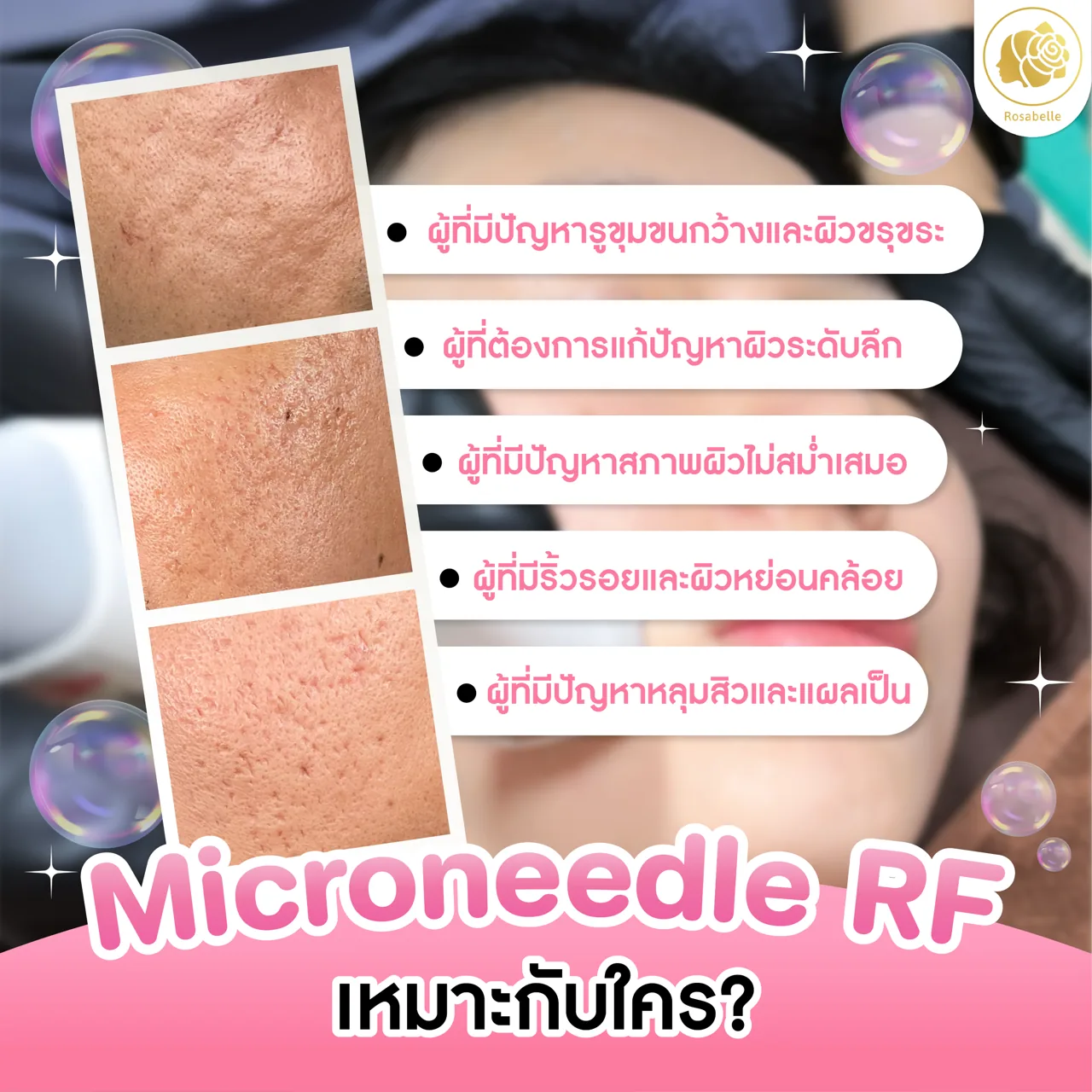 โปรแกรม Microneedle RF คืออะไร? เหมาะกับใคร และพักฟื้นอย่างไร