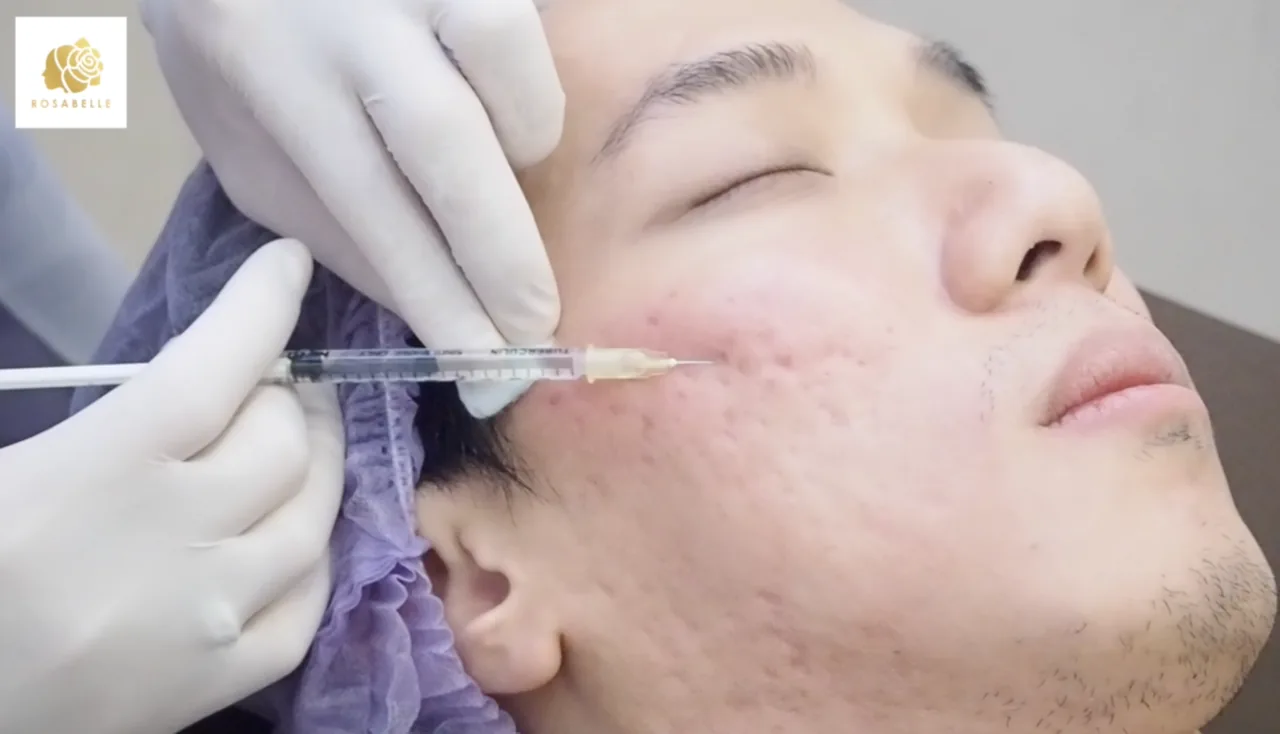 Subcision เทคนิคการรักษาหลุมสิว และข้อควรรู้ก่อนทำ