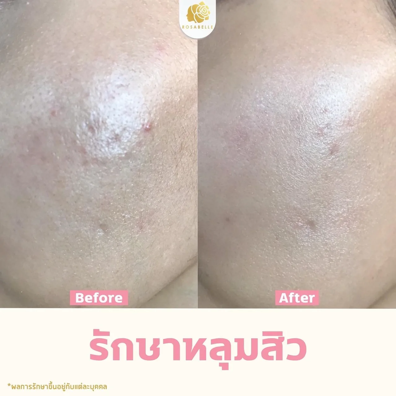 ภาพประกอบรักษาหลุมสิวที่โรสเบลล์คลินิก ประเมินชนิดหลุมสิวก่อนรักษา ลำดับที่ 6