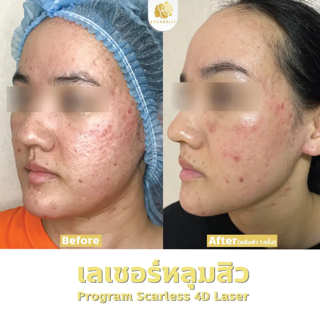 รักษาหลุมสิว รูขุมขนกว้าง และการประเมินก่อนรักษา โรสเบลล์คลินิกสาขาดินแดง
