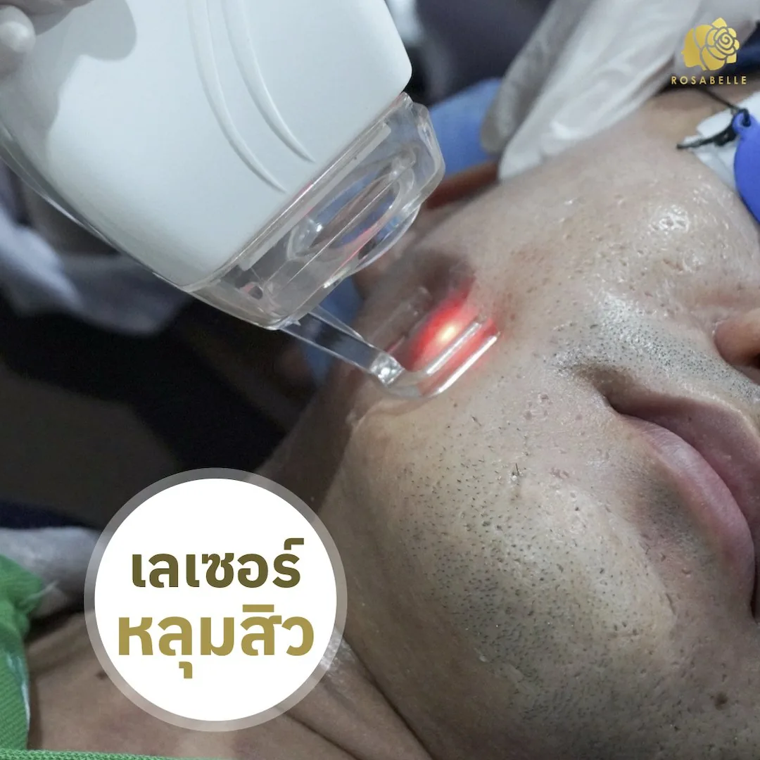 แนวทางรักษาหลุมสิวและข้อควรรู้ก่อนทำ