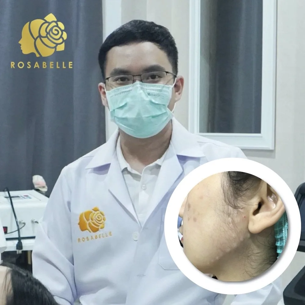 โปรแกรมฉีดโบทูลินุ่มท็อกซินลิฟท์กรอบหน้าคืออะไร