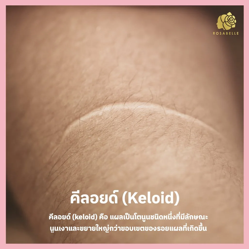 คีลอยด์ (Keloid) คืออะไร และรักษาได้อย่างไรดี