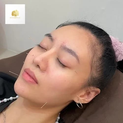 การฝังเข็มกับปัญหาสิว: ข้อควรรู้ก่อนเลือกการดูแล