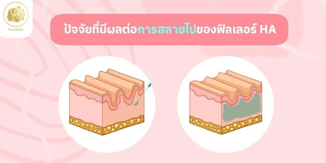 ปัจจัยอะไรบ้างที่ทำให้ฟิลเลอร์สลายไปได้เร็ว?