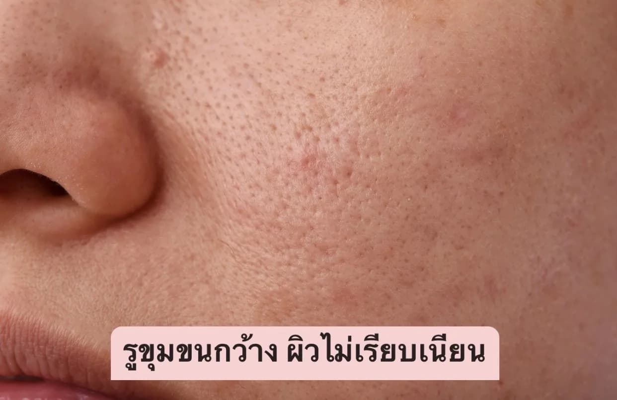 วิธีรักษาปัญหารูขุมขนกว้างบนใบหน้า ให้เรียบเนียน