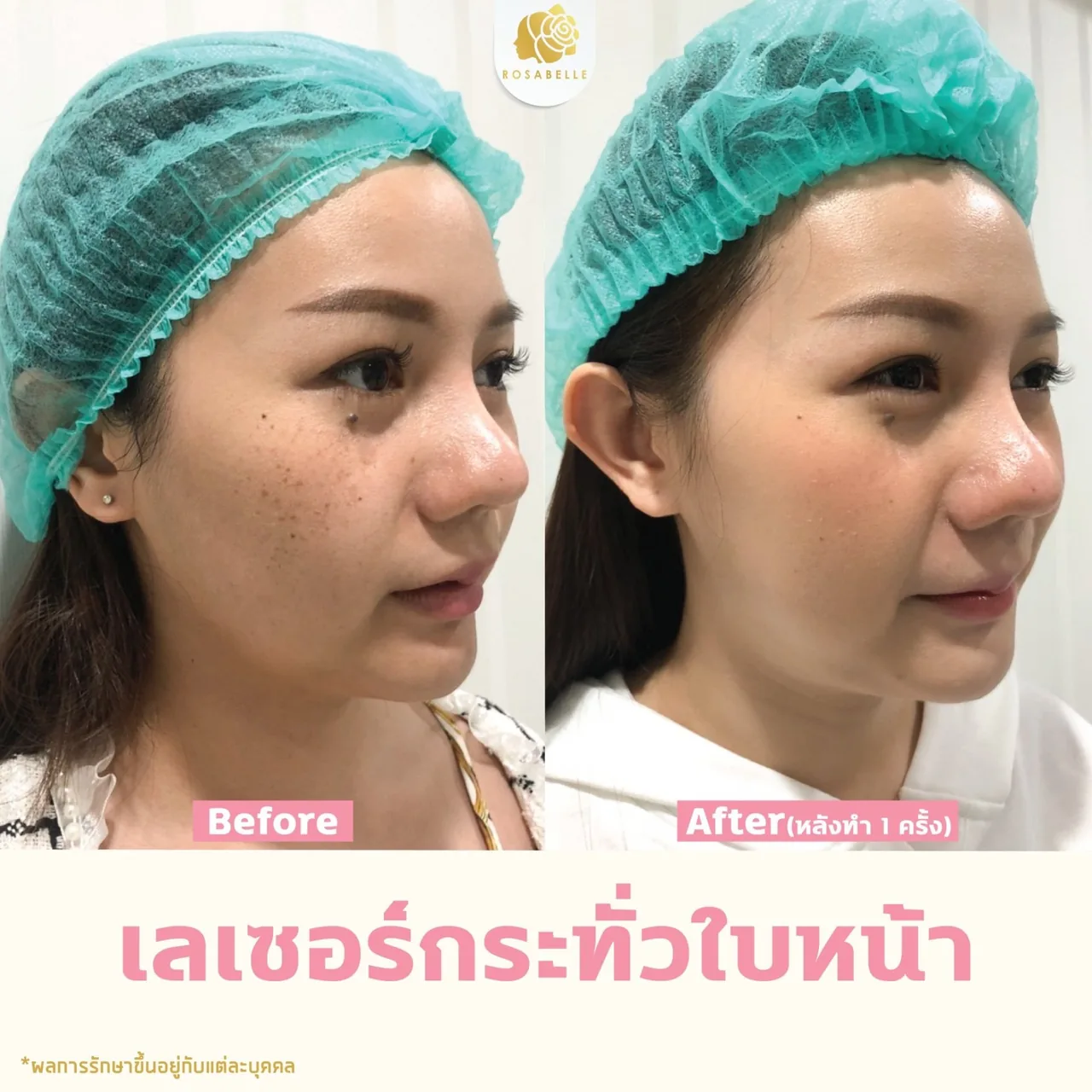 ข้อควรรู้ก่อนดูแลผิวด้วยเลเซอร์