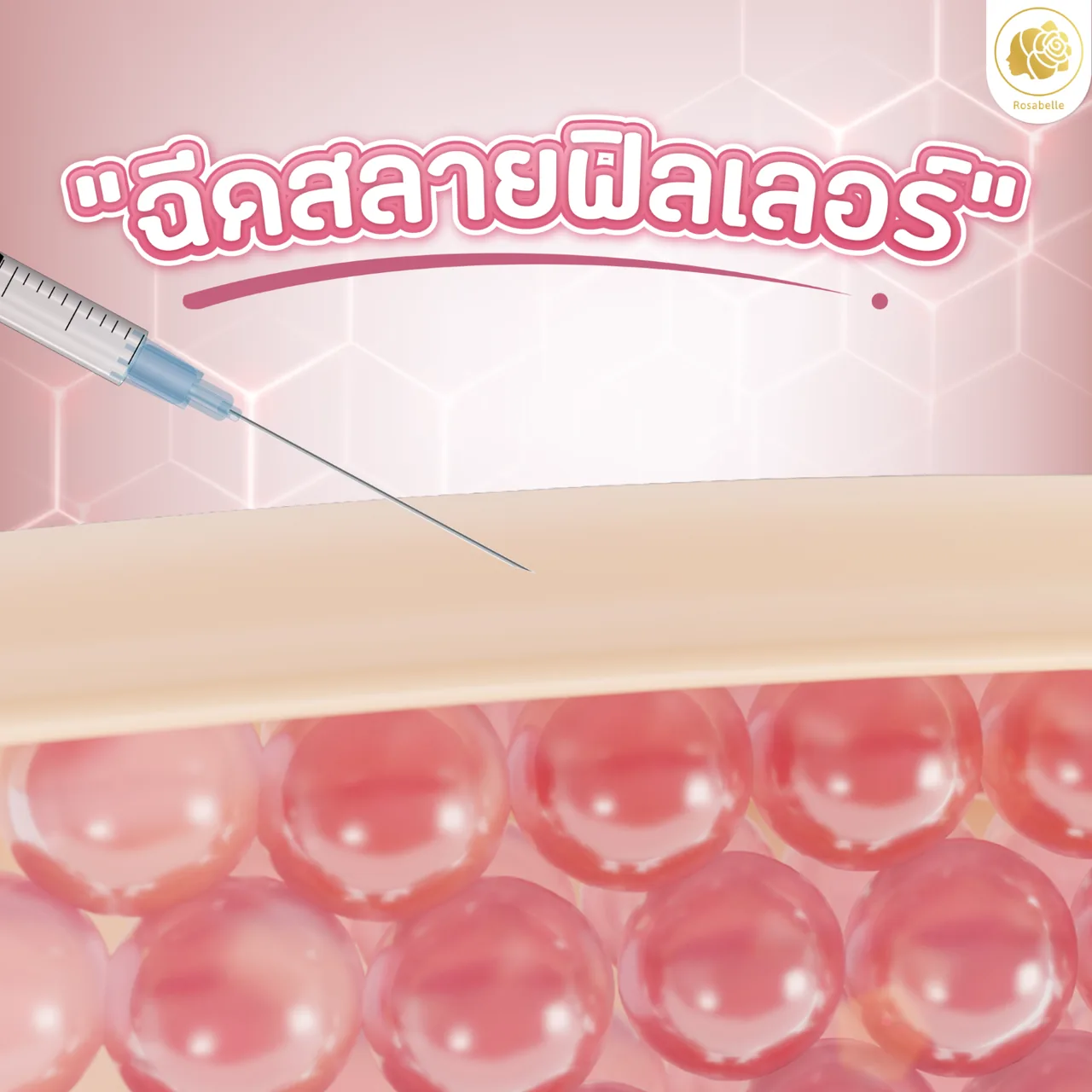 ฉีดสลายฟิลเลอร์ สลายได้หมดไหม และควรทำกี่ครั้ง