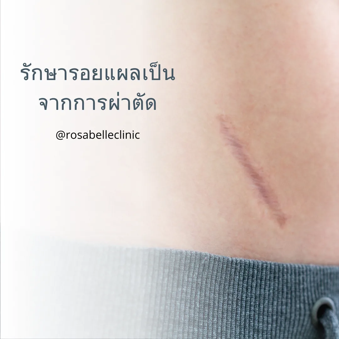 รักษารอยแผลเป็นจากการผ่าตัดด้วยเลเซอร์