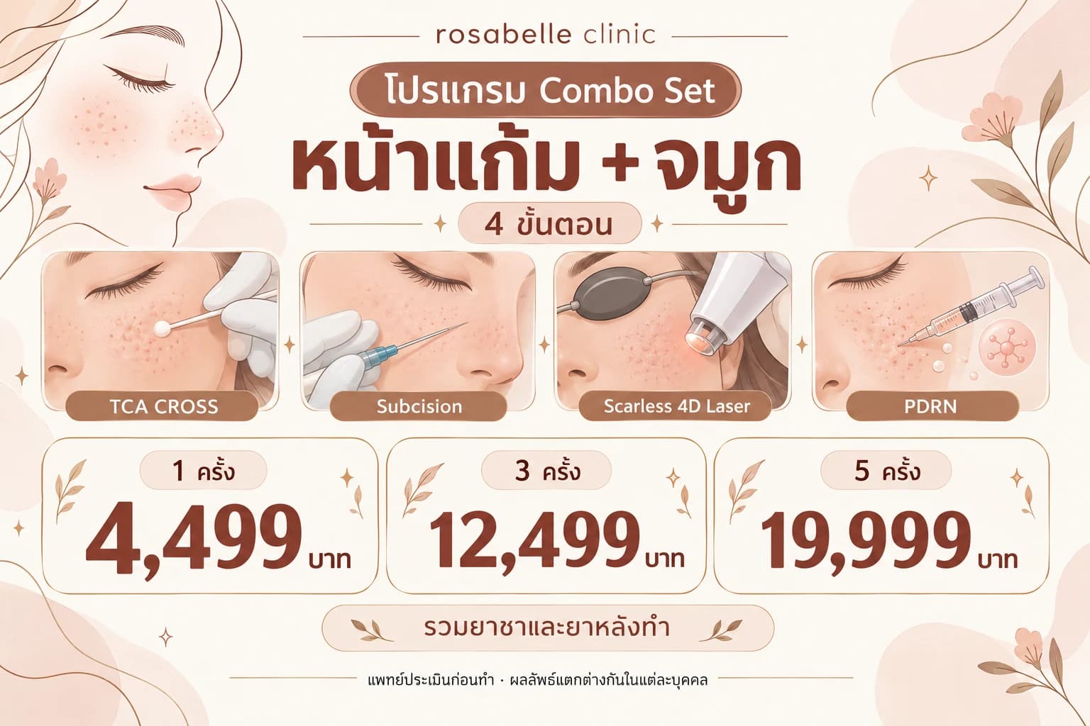 โปรแกรม Combo Set หน้าแก้มและจมูก: 4 ขั้นตอน ราคา และรีวิว