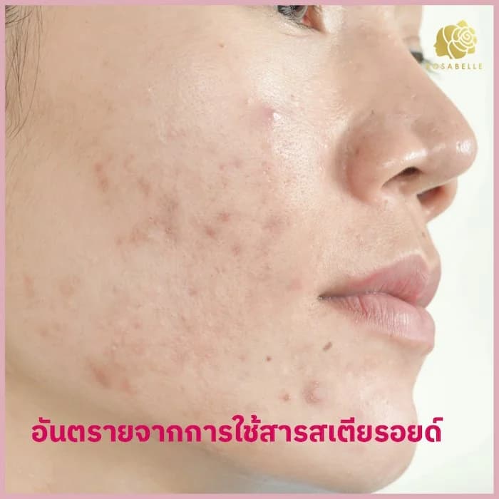 สเตียรอยด์คืออะไร? ประโยชน์ ความเสี่ยง และการใช้ให้เหมาะสม