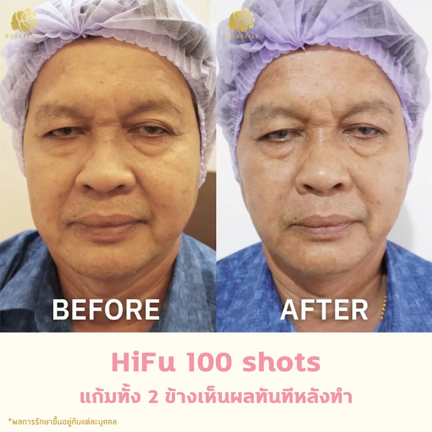 ภาพประกอบบทความ Linear HIFU program: skin lifting, risks and aftercare