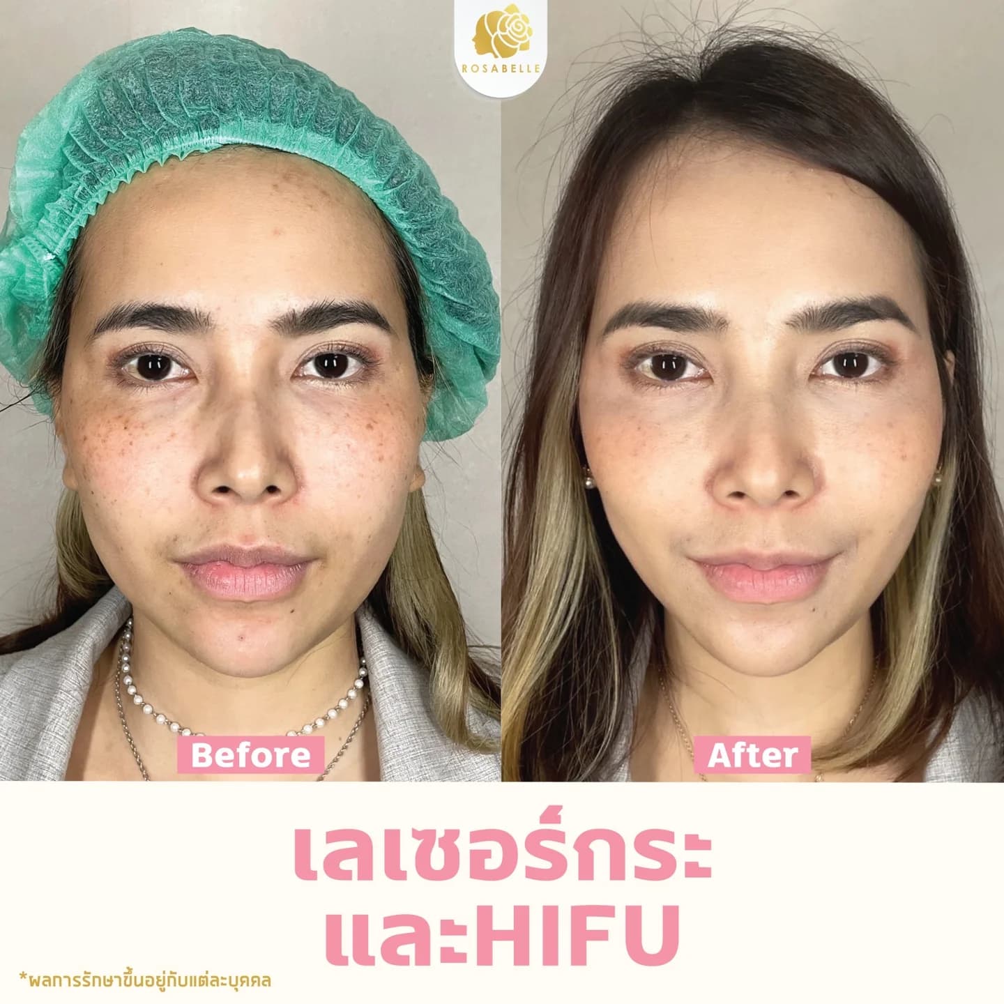 ภาพประกอบบทความ Linear HIFU program: skin lifting, risks and aftercare