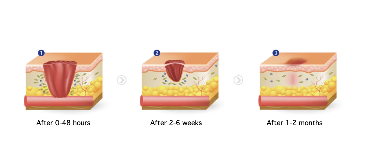 ภาพประกอบบทความ Linear HIFU program: skin lifting, risks and aftercare