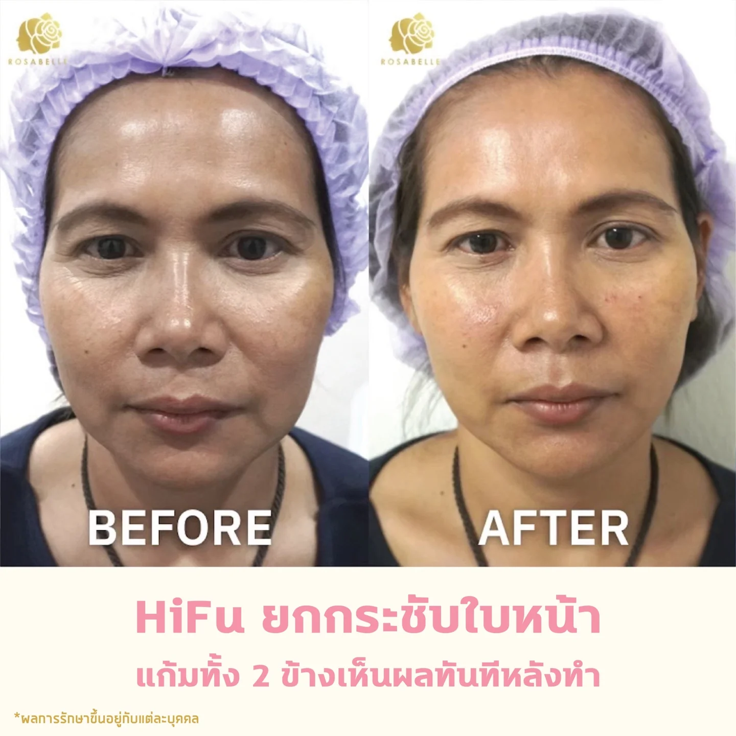 ภาพประกอบบทความ Linear HIFU program: skin lifting, risks and aftercare
