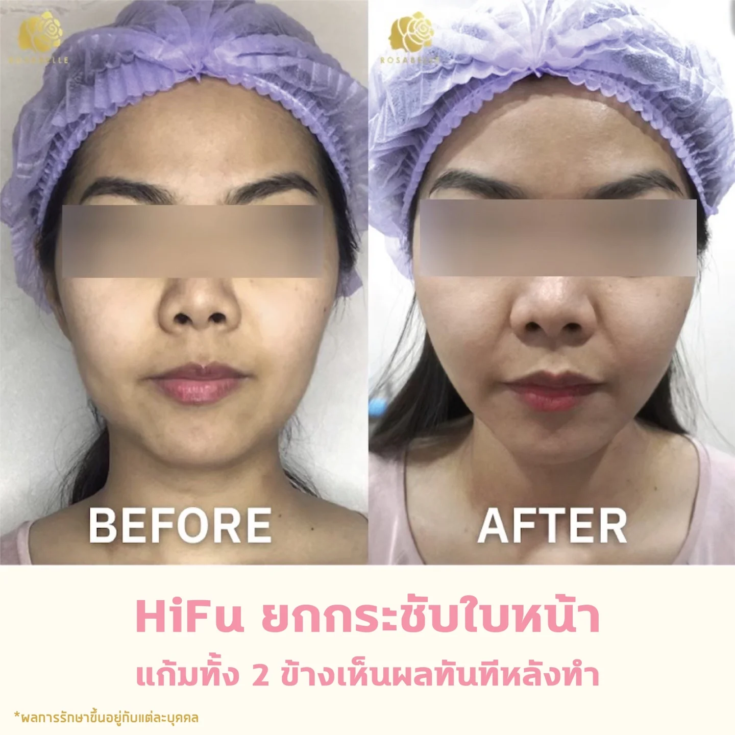 ภาพประกอบบทความ Linear HIFU program: skin lifting, risks and aftercare
